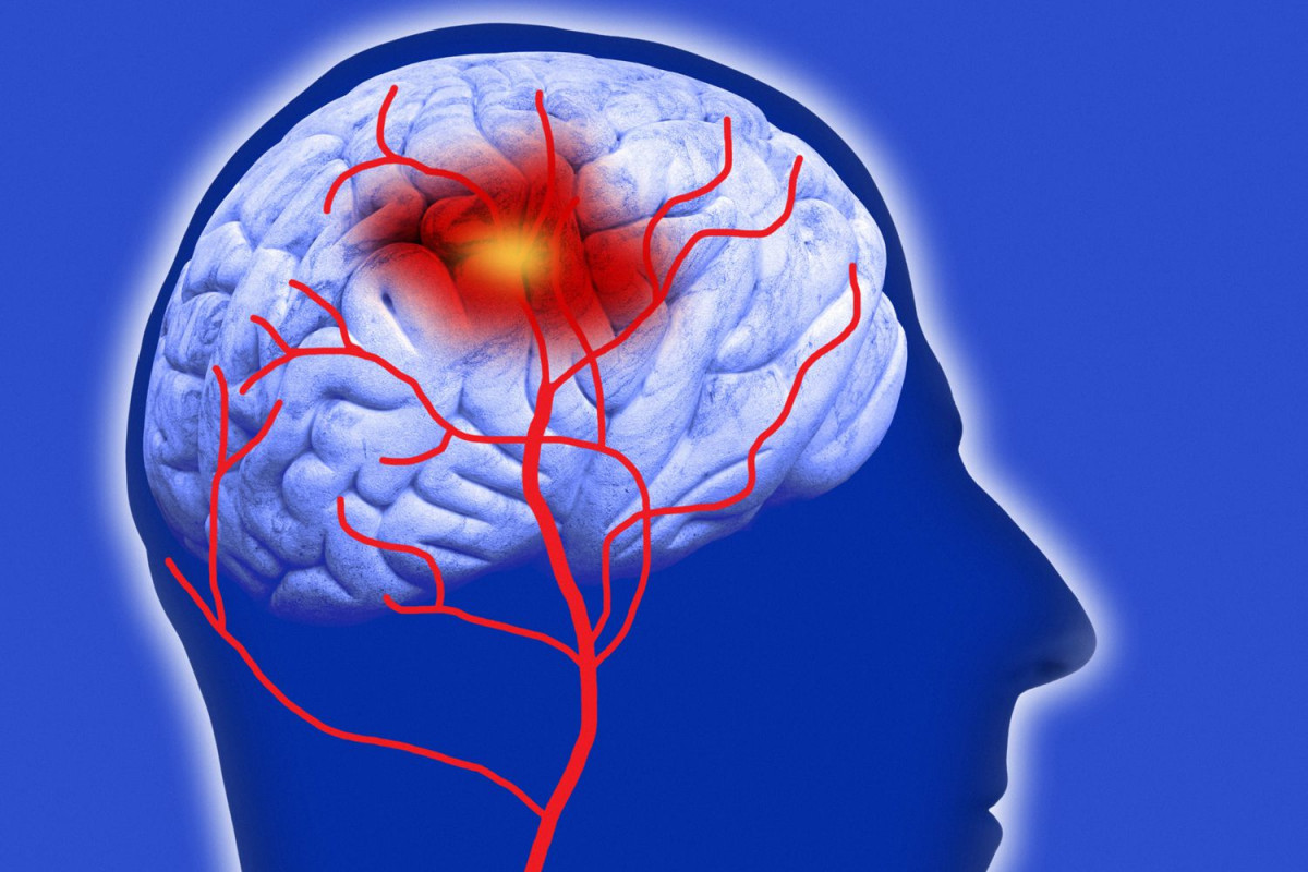 Consecuencias Neurocognitivas del infarto cerebral. 8 síntomas o alteraciones importantes a tomar en cuenta.