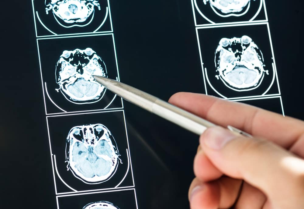¿Cuáles son los signos de un ataque cerebral y cuáles pueden ser sus secuelas?