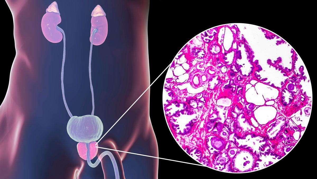 Agrandamiento de la Próstata en el Adulto Mayor. ¿Qué es y cómo identificarlo?